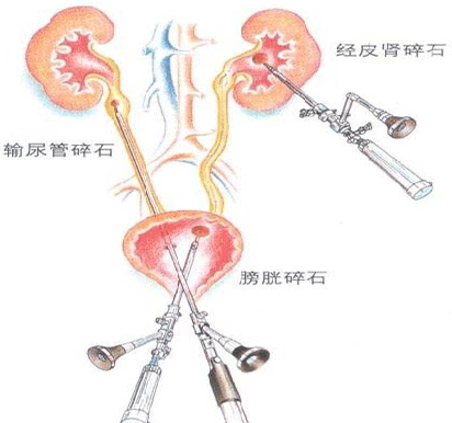 肾结石没掉下来怎么办