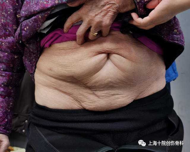 人口骨折率_腿骨折图片(2)