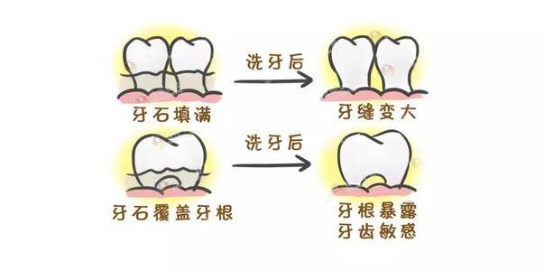 为什么医生总是建议你洗牙真不是在坑钱