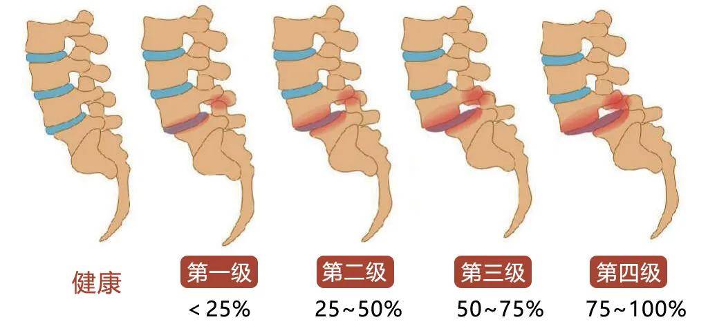 郴州骨科医院教授提醒下背痛当心腰椎滑脱压迫神经
