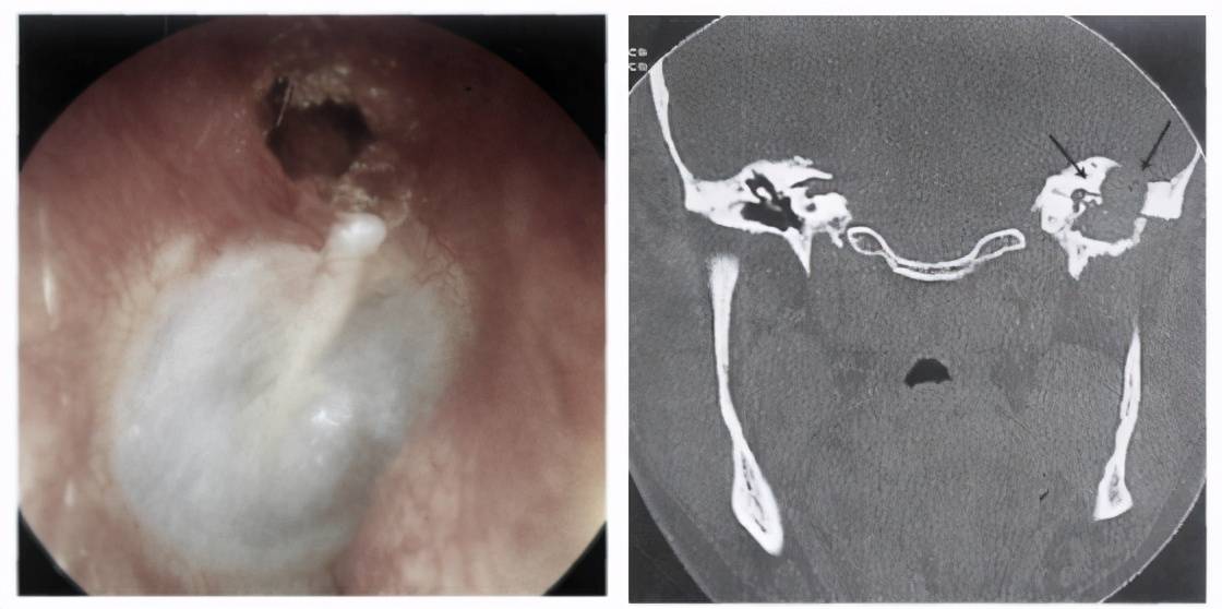 耳鼻咽喉科医生手记耳朵反复流脓听力下降小心长有胆脂瘤
