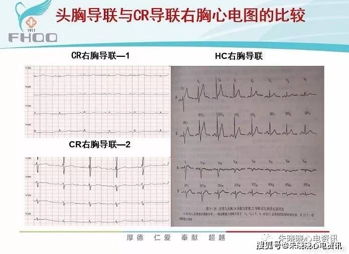 心肌缺血的心电图表现