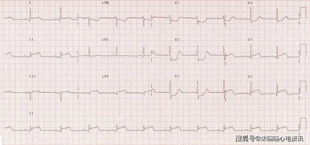心肌缺血的心电图表现