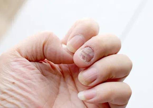 指趾甲异常就是灰指甲吗