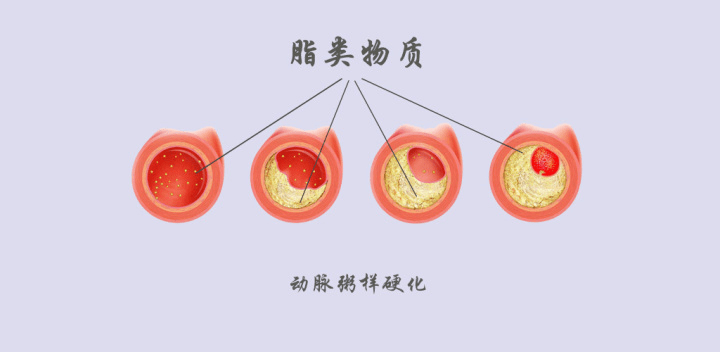 动脉粥样硬化是怎么形成的?血塞通滴丸的功效如何?为什么要吃?