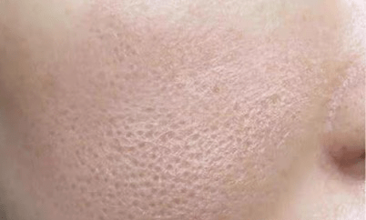 怎么解决毛孔粗大的问题 688131f5fef64086bdda94bc407bf9ab.png