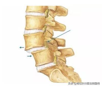 腰l5-骶s1腰椎滑脱,椎间盘突出压迫神经,走路困难该怎么办?