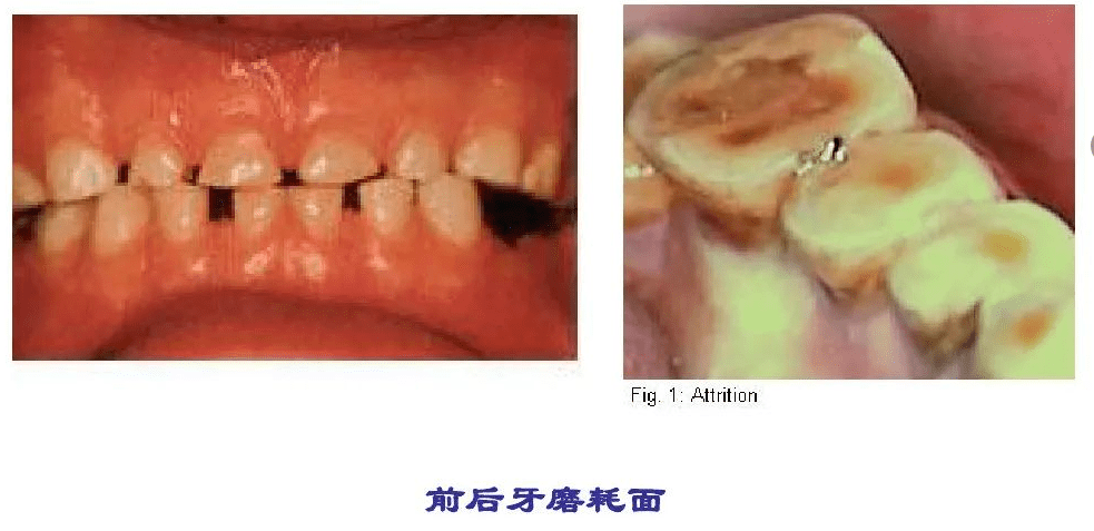 磨牙症的临床症状和治疗手段