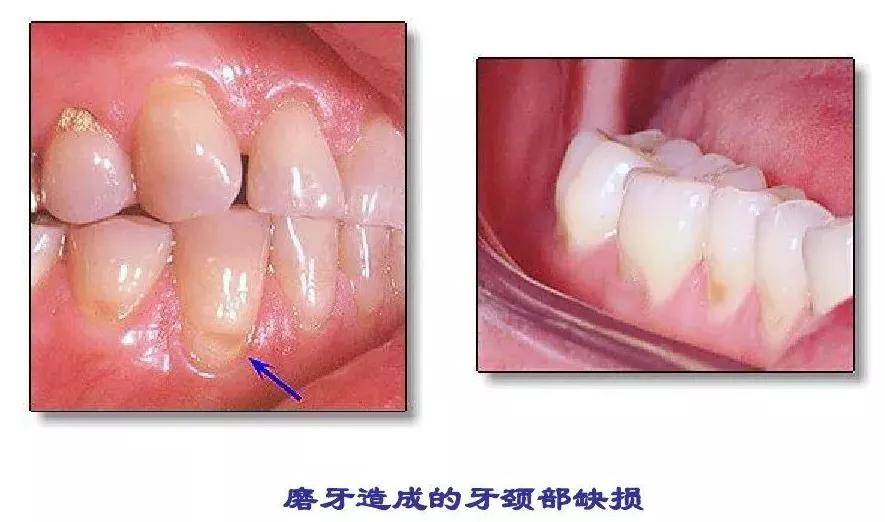 磨牙症的临床症状和治疗手段_咬合