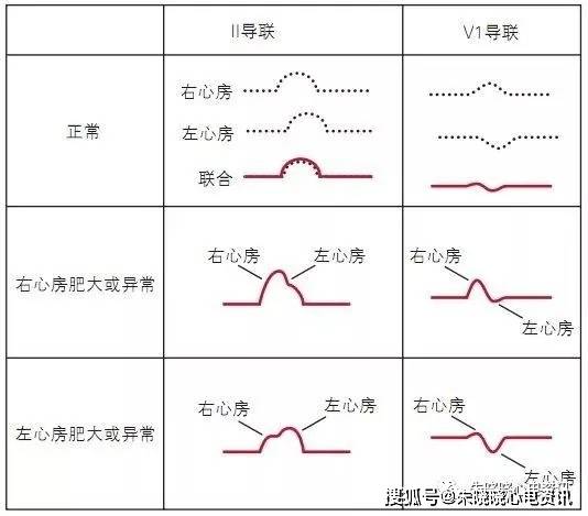 一句话掌握心电图解读要点-- "律和率,轴和肌,房室传导波段期"