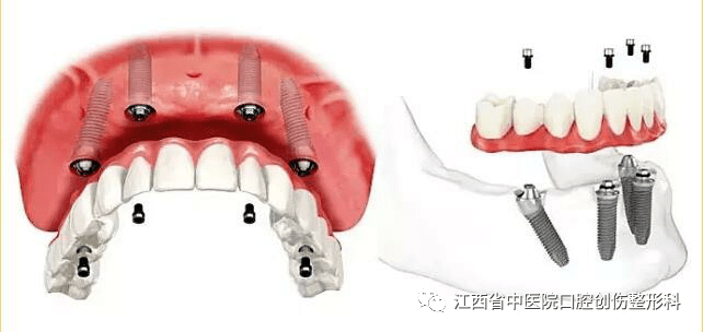 4颗植体,就能种出半口牙!
