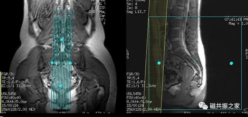 磁共振(mri)骶尾椎扫描技术