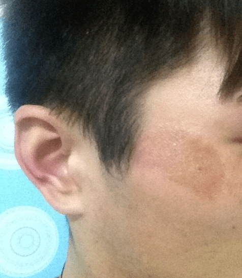 上海长江疤痕医院专家 告诉你色素沉着疤痕是怎么回事
