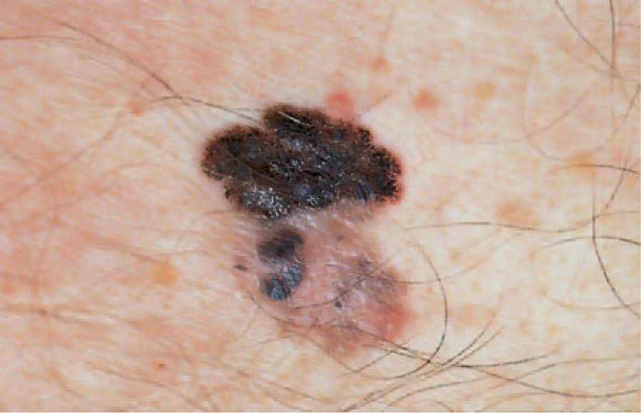 由于皮肤上的恶性黑色素瘤也是由痣引起的,所以黑色素瘤的病因和发病