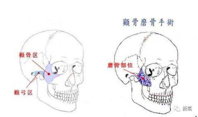 90%的顶级神颜都悄咪咪动了这里,不过没人看得出!_颧骨