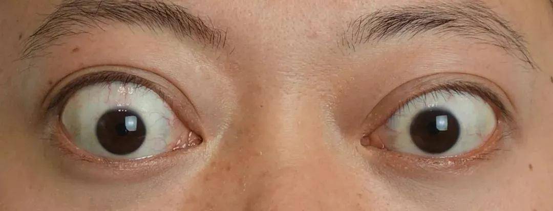 中度患者 主要表现为眼球突出较明显,白眼仁增多,畏光流泪,眼睛胀痛