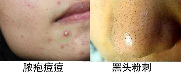 痤疮痘痘为什么喜欢脸上?
