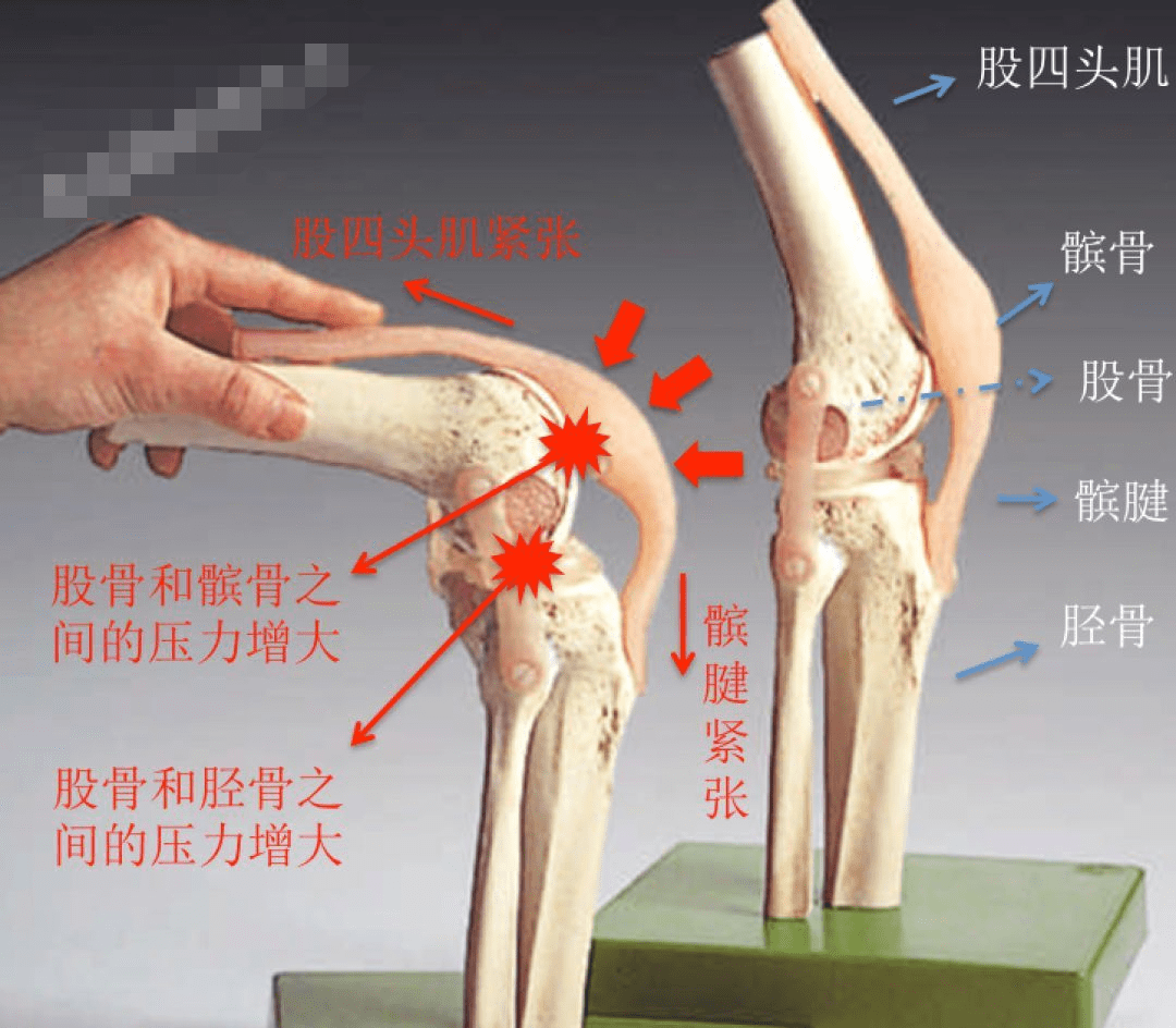 膝关节解剖图保守治疗如果出现了膝关节的疼痛,根据症状的轻重,我们