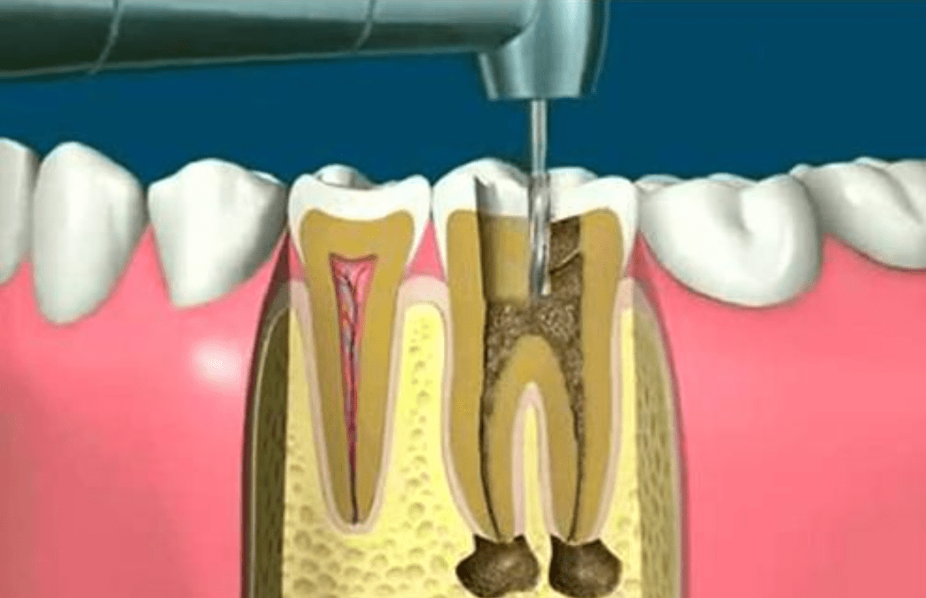 王刃医生科普:牙医说要做"根管治疗",那么什么是根管治疗呢?