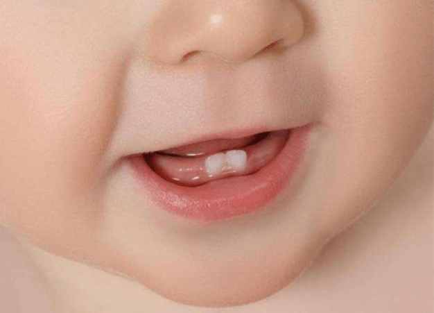 门牙",紧接着会挨着上下4颗牙齿长出 旁边的乳牙,过了这个阶段后,宝宝
