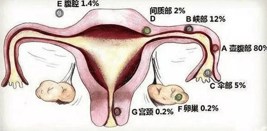 原创咸阳和仁妇产医院成功完成右侧输卵管壶腹部妊娠手术!