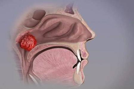 首大石萍:腺样体肥大的病因有哪些