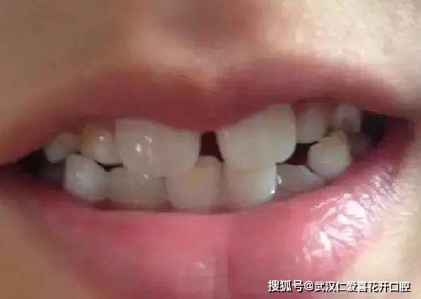 孩子在换牙的年龄门牙出现大缝,用看医生吗?