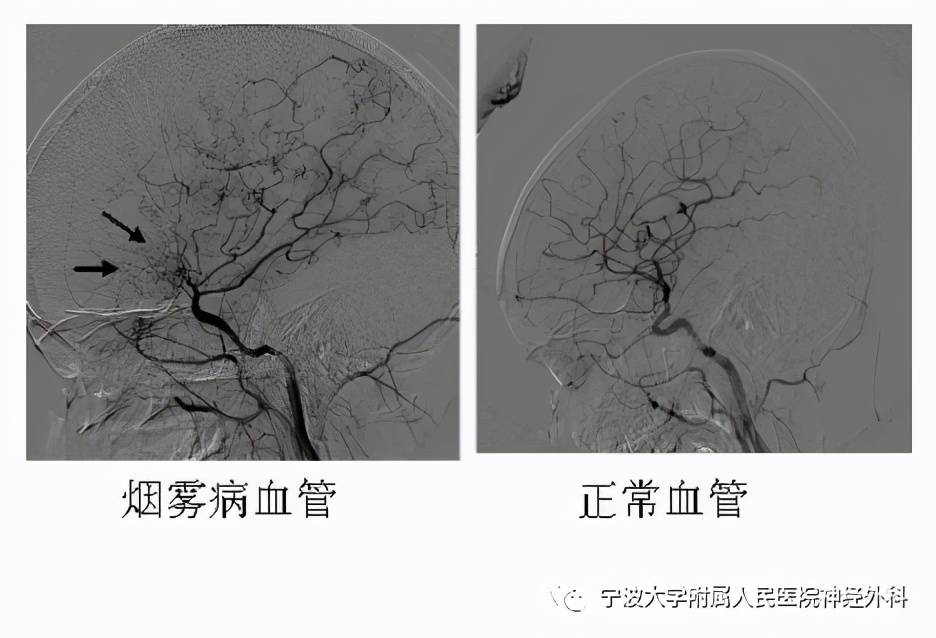 名医访谈:烟雾病那些事儿!