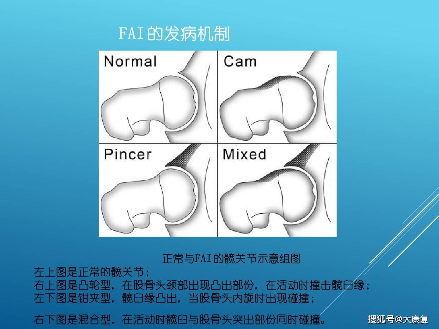 股髋关节撞击综合症