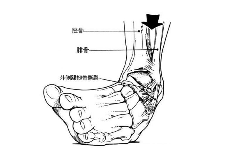 出现脚踝在内翻的状态下着地,导致外侧的肌肉,韧带,骨头出现拉伤