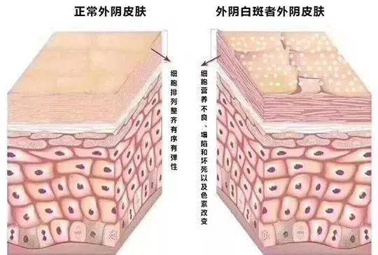 外阴瘙痒症状消失表示外阴白斑开始恢复