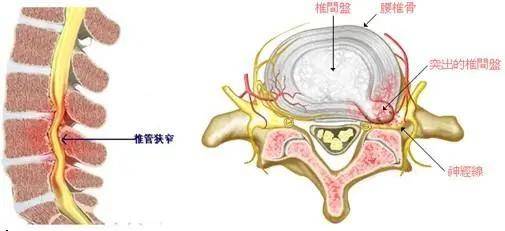 目前临床上常用的针对腰椎管狭窄症的微创手术方法包括:1椎间盘镜下或