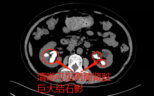 患者确诊为双肾多发性结石,含铸型结石,左肾最大结石27*10mm,右肾最大