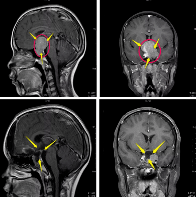 视力下降1年,自行喝偏方半年,出现头痛就诊,确诊为 5x4x3cm垂体瘤