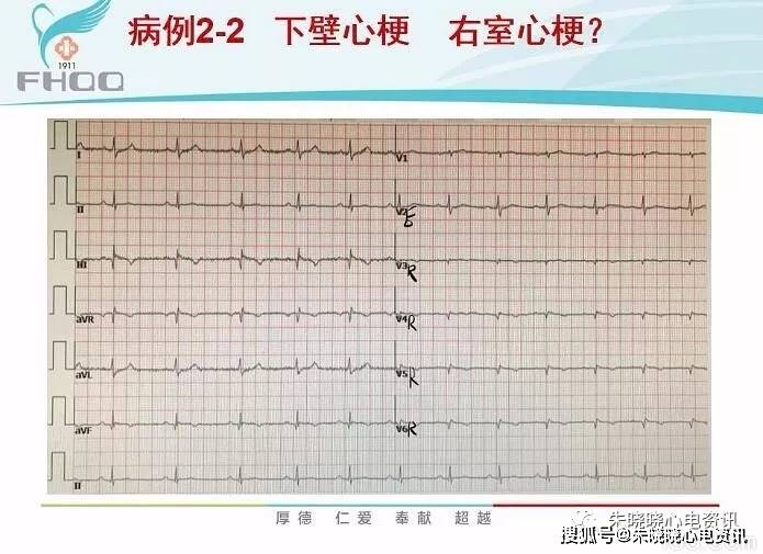 右室心肌梗死的心电图诊断