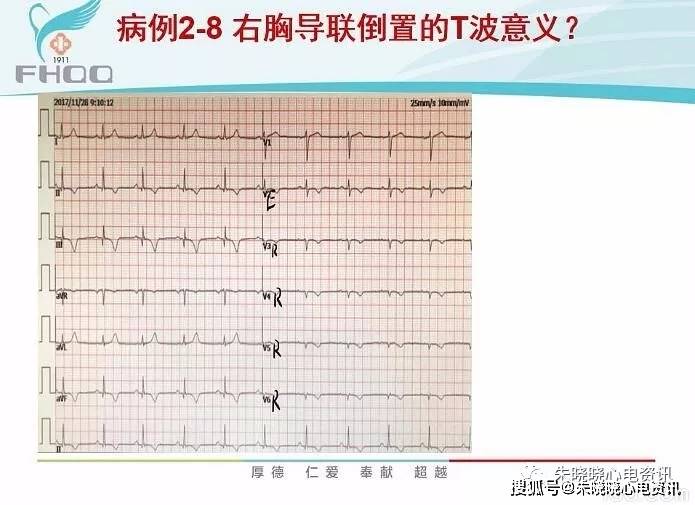 右室心肌梗死的心电图诊断