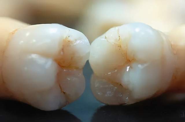 牙齿衰老年轻化,提前掉牙不是"危言耸听",你的牙还好吗?