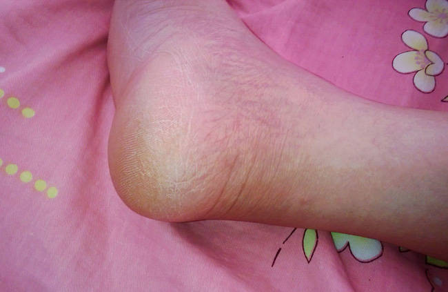 脚气 这类一般常见于脚趾,脚掌,脚面,脚后跟,起初为干燥起皮,严重者