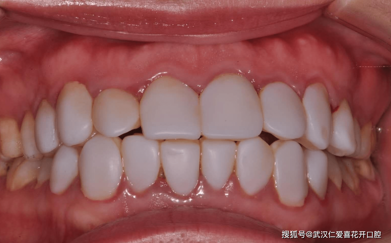 6d纳米浮雕牙这样的牙齿没有层次感,看起来非常死板不自然!