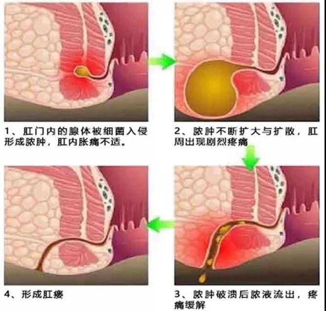 "菊"部长个包,你以为只是"火疖子"?小心,别把自己往火坑里推