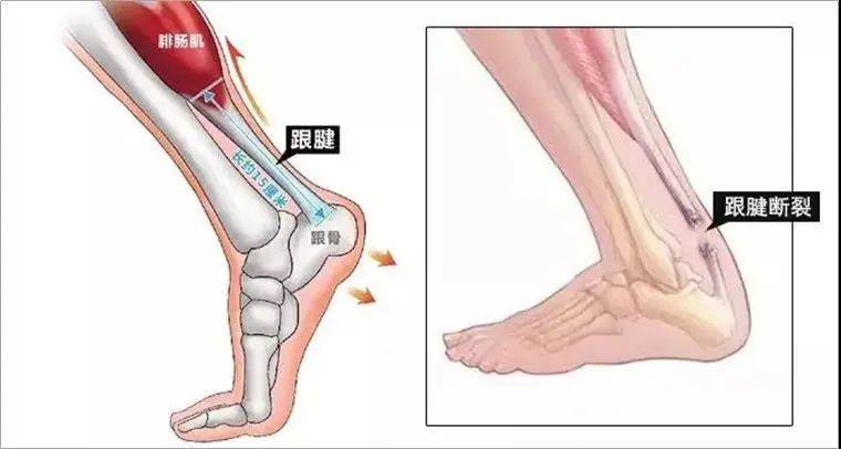 跟腱断裂,术后康复治疗至关重要!