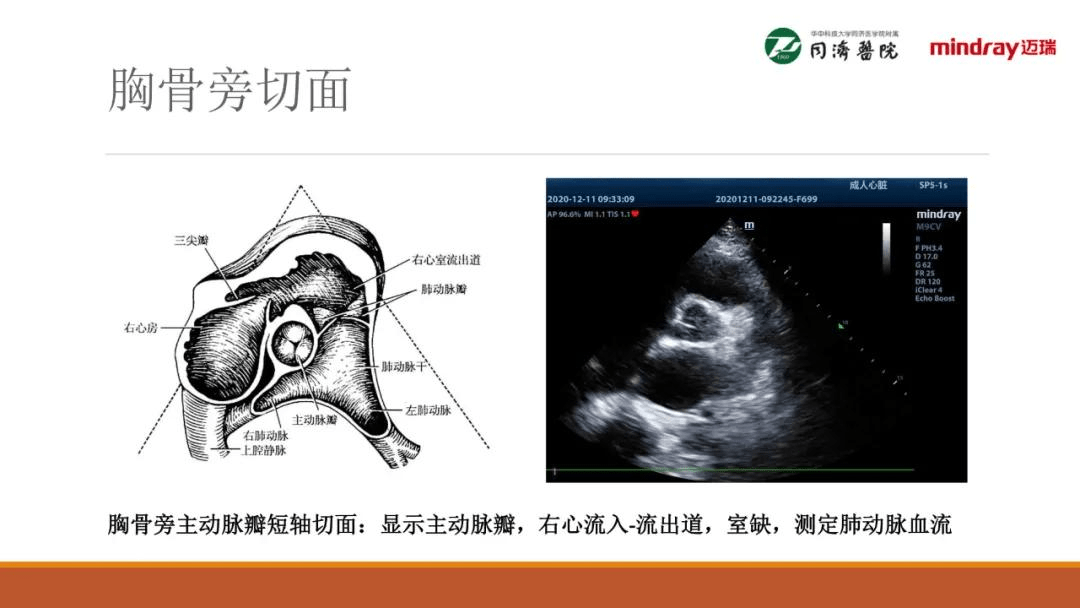 围术期经胸超声心动图(tte)