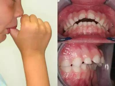 大龄儿童长期吃手指,会由于施力不当,导致上下颚变形,进而会影响面容