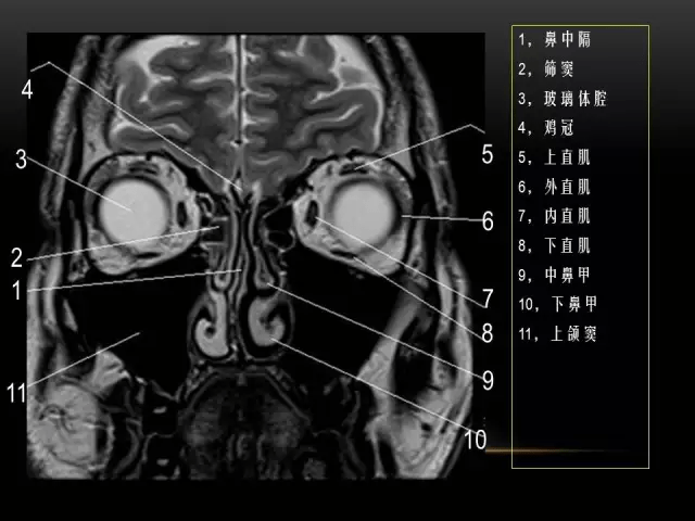 mri下眼部及鼻窦解剖图谱