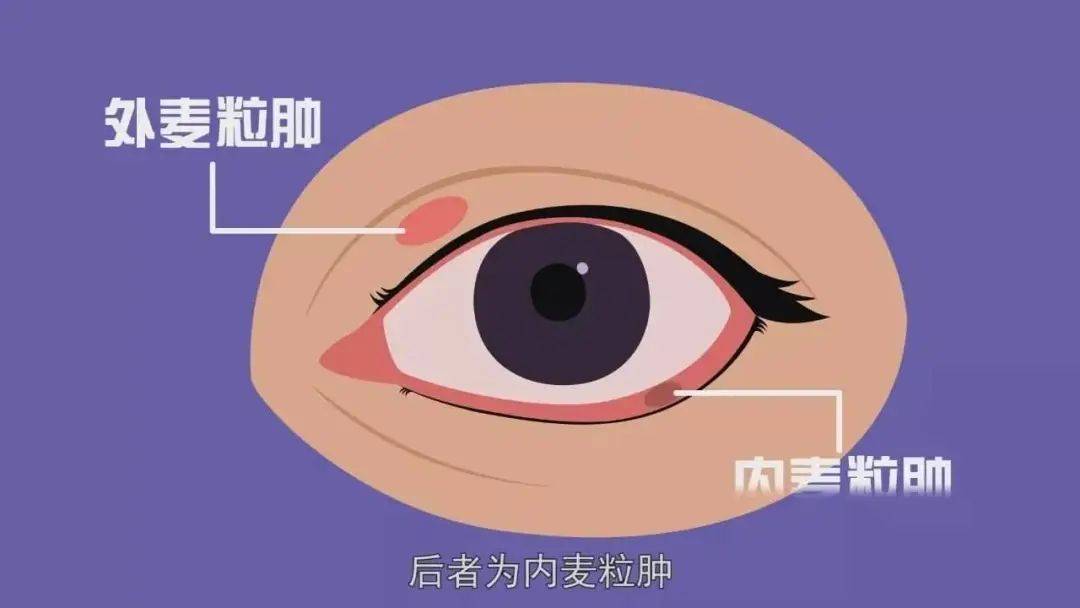 针眼是不是麦粒肿?_眼睑