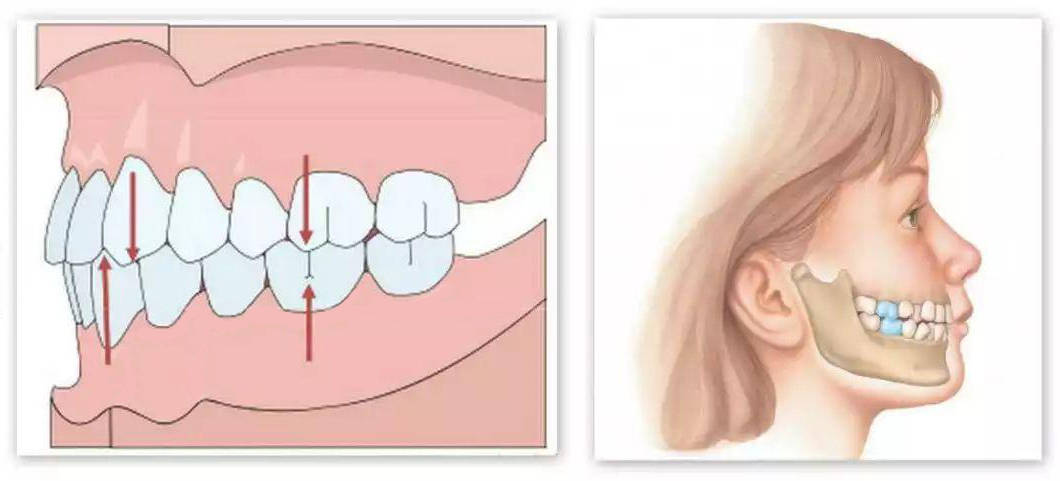 面部中线与牙齿中线一致 中线不齐原因: 颌骨发育不足,不能提供足够的