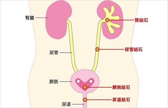 另外,儿童时期出现尿道口发育异常,同样可引起尿分叉,治疗起来比较