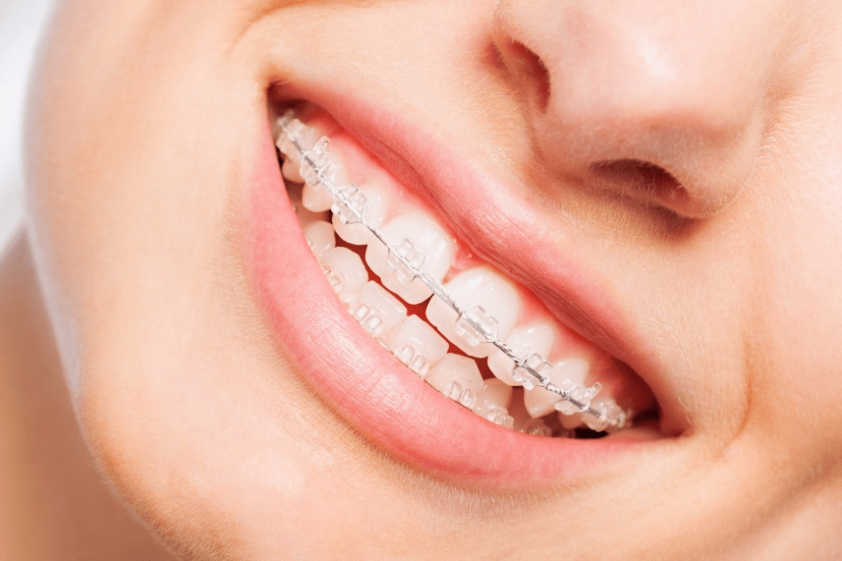 新疆臻美口腔:牙齿矫正戴牙套一般需要多久?