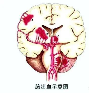 脑溢血的严重程度取决于出血的部位和出血量关注微信公众号 国医百