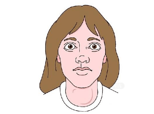 5,甲状腺肿大